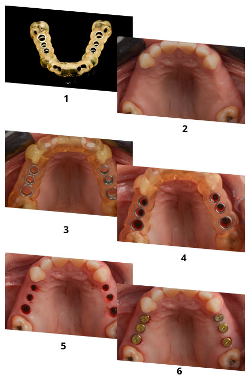 Guias cirúrgicos para implantes com planejamento e execução precisos, utilizando softwares como Exoplan, Codiagnostix e Blue Sky, e arquivos DICOM e STL para tomografia e escaneamento.