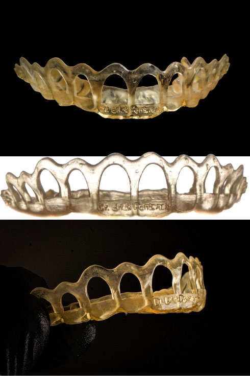 Guias cirúrgicos periodontais para correção de sorriso gengival, com planejamento de gengivectomia e ostectomia, e uso de tomografia e enceramento virtual com Smile Cloud, Exocad ou DSD.