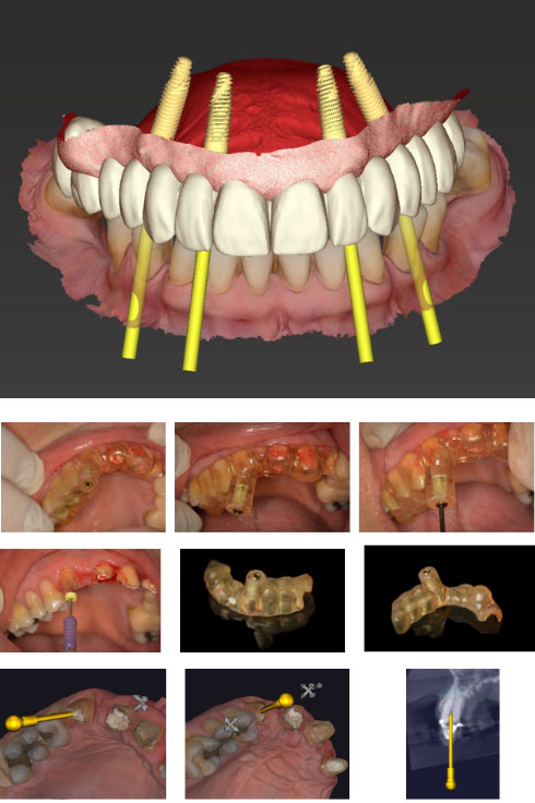 Endoguide para acesso ao canal radicular com escaneamento digital intraoral e tomografia, utilizando tomografia de alta resolução, kits de cirurgia guiada e impressão em resina de alta resistência.