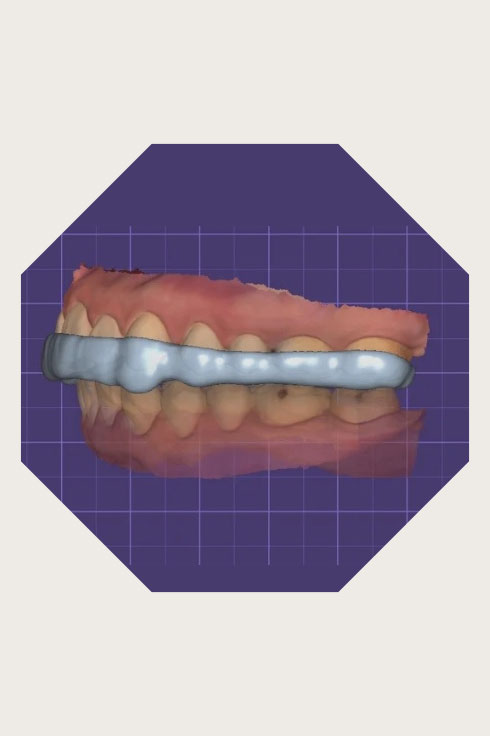 Placa oclusal impressa via fluxo digital com escaneamentos superior, inferior e registro, utilizando resinas específicas e planejamento em Exocad® e Medit Link.